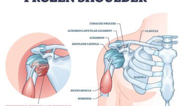 frozen shoulder