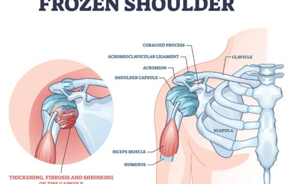 frozen shoulder