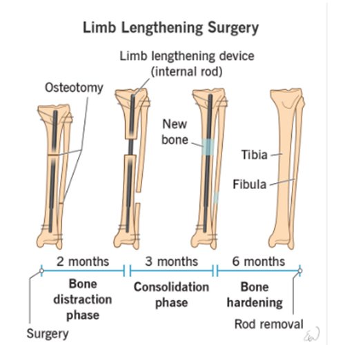 limb-lengthening-global-healthcare-india