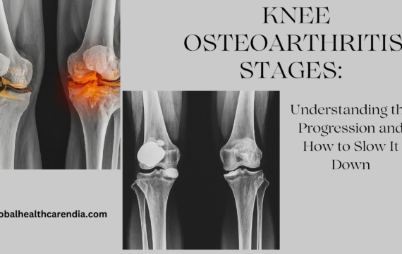 Knee Osteoarthritis Stages