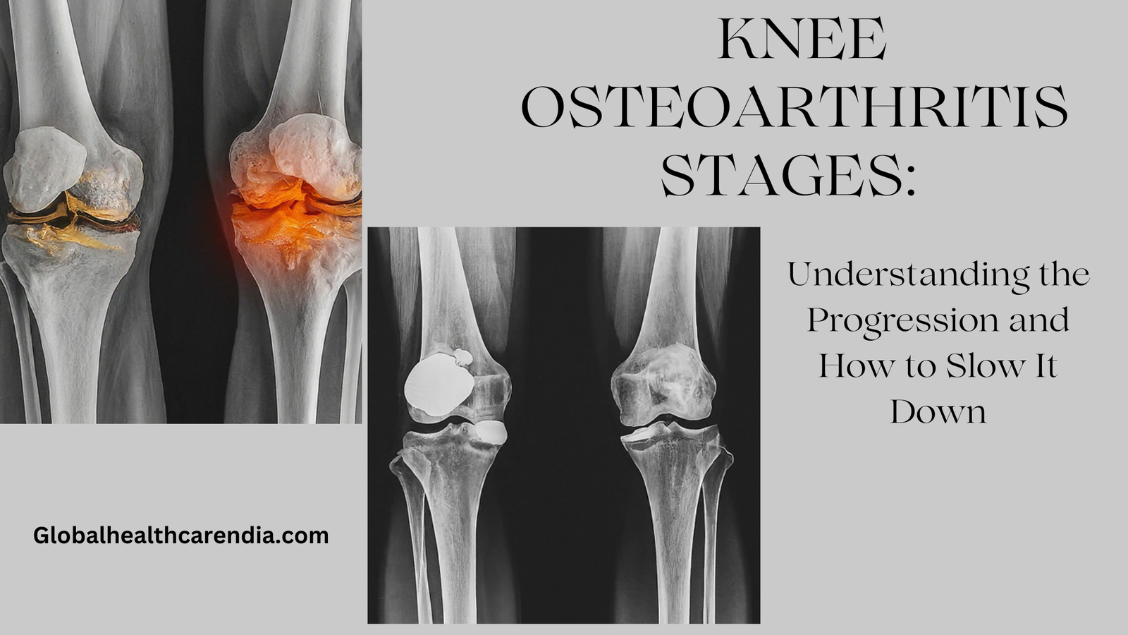 Knee Osteoarthritis Stages