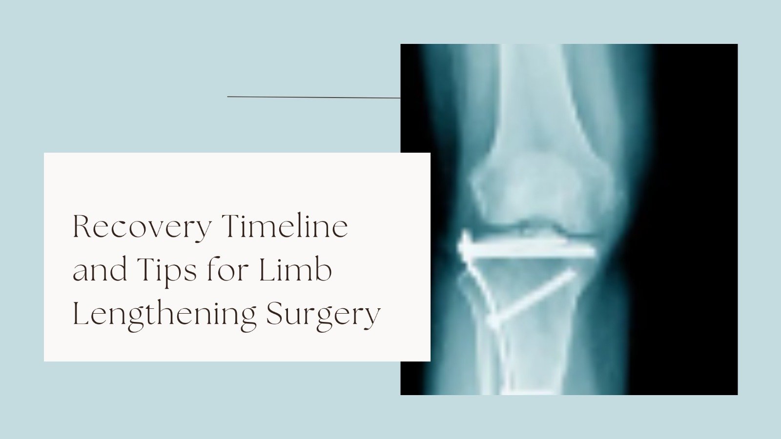 Recovery Timeline and Tips for Limb Lengthening Surgery