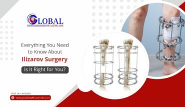 Everything You Need to Know About Ilizarov Surgery