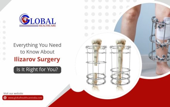 Everything You Need to Know About Ilizarov Surgery